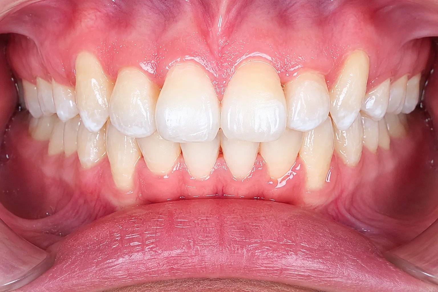 Self-Ligating braces - After
